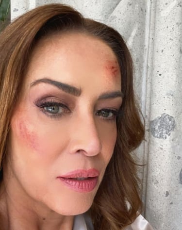 Anette Michel aparece en redes sociales con el rostro golpeado