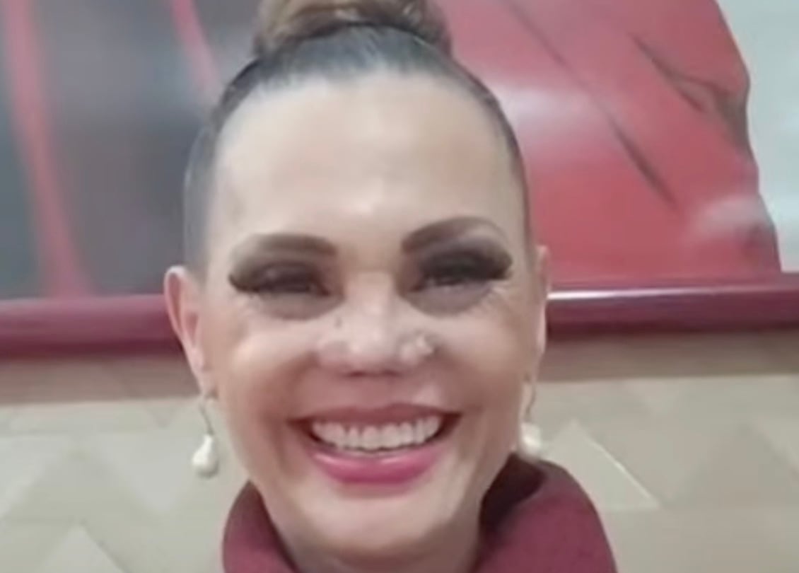 Carmen Campuzano se sometió a una nueva cirugía de nariz y así luce