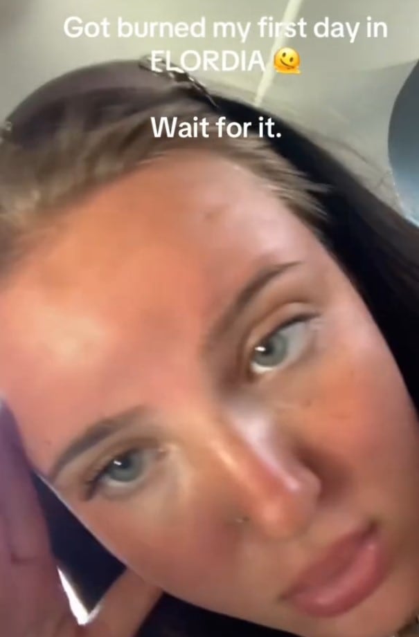 Se le hinchó toda la frente después de tomar el Sol y muestra en TikTok cómo le quedó