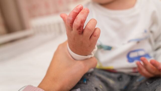 Detectan Virus Coxsackie en Hidalgo