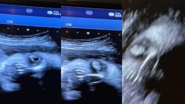 Ultrasonido de bebé aterroriza a TikTok por su cara demoníaca