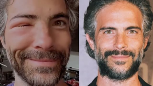 A Osvaldo Benavides lo pica una abeja