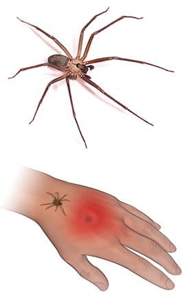 Estos son los síntomas de una picadura de araña violinista