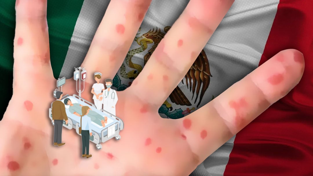Brote de sarampión en México