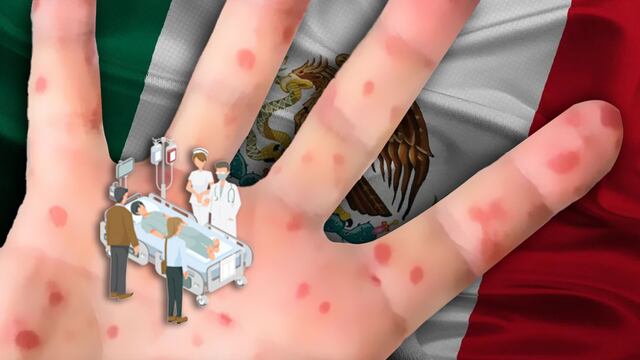 Casos y muertes por sarampión en México