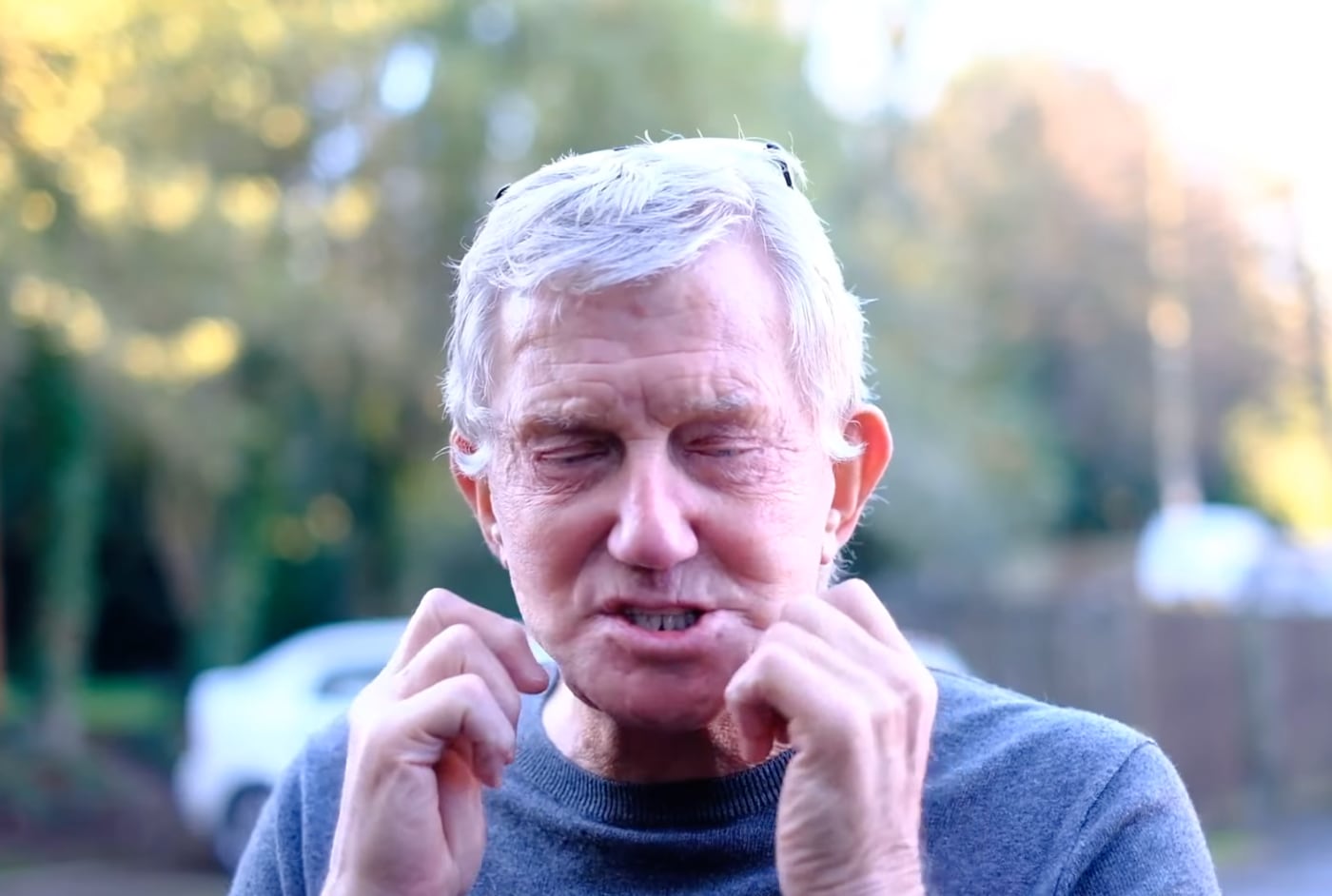 Pete Broadhurst después de la cirugía estética