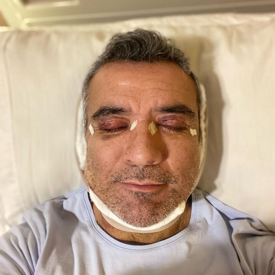 Héctor Sandarti aparece con moretones en el rostro.