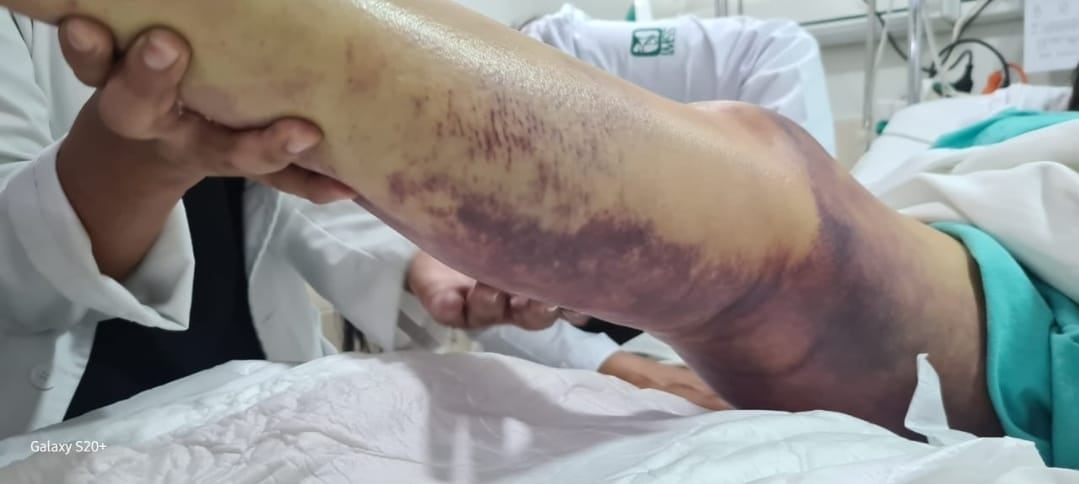 Hospital La Raza del IMSS salva vida a paciente mordida por víbora