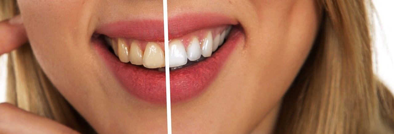 Con esta planta medicinal blanquearás tus dientes