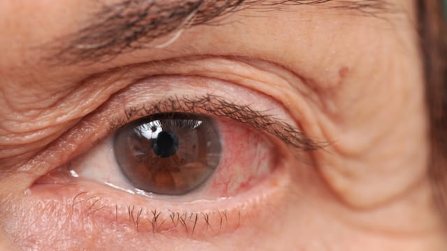 La enfermedad hace que se acumule líquido dentro del ojo que ejerce presión sobre el nervio óptico.