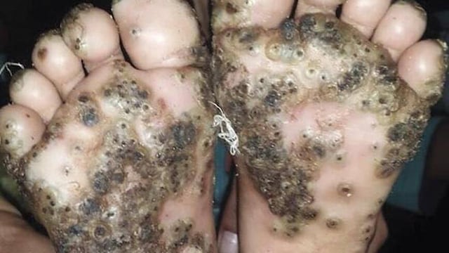 Tungiasis.