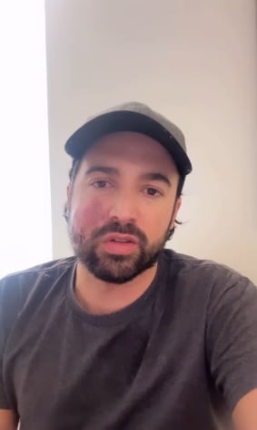 Carlos Girón comparte haber sido mordido por un perro.