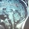 Tras insoportables dolores de cabeza, le encuentran más de 700 tenias en el cerebro