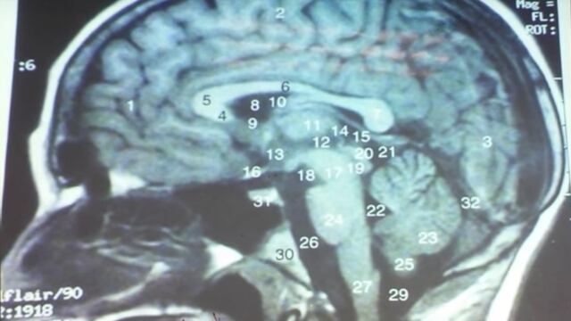Hallan más de 700 tenias en su cerebro.