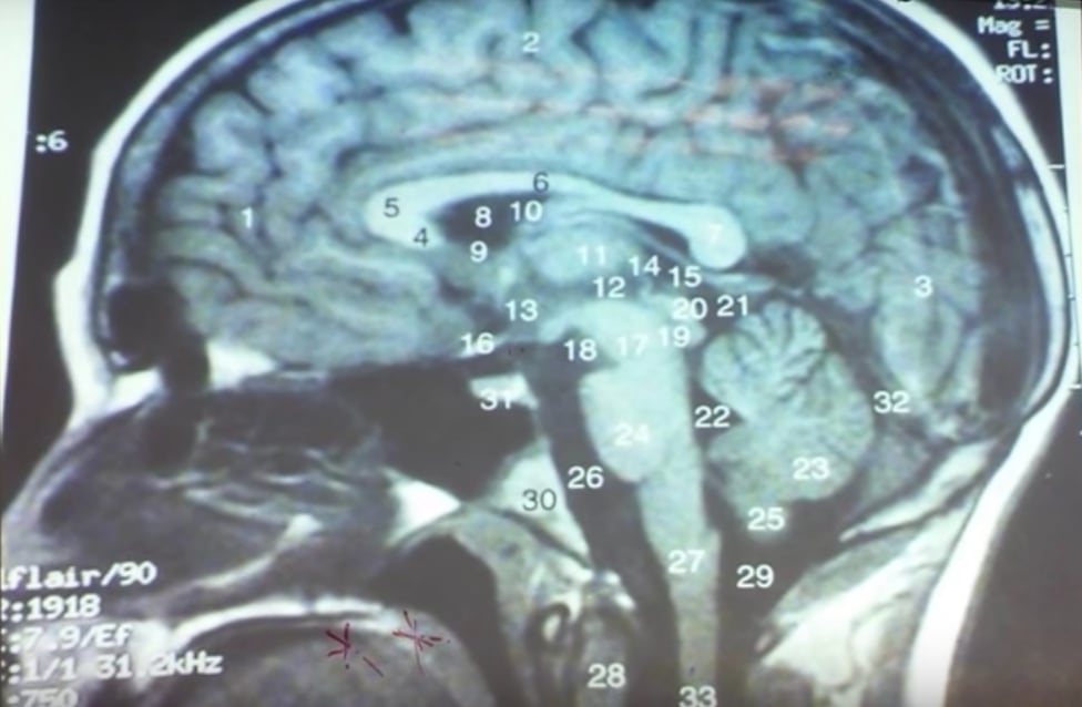 Hallan más de 700 tenias en su cerebro.