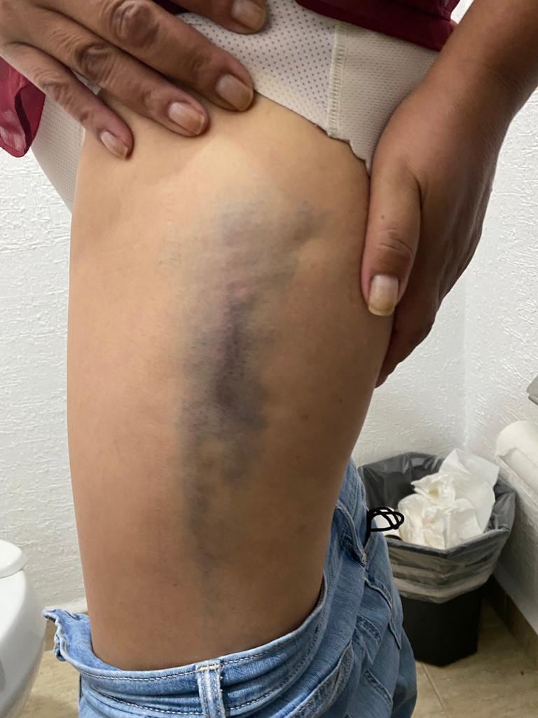 moretones y golpes a la víctima agredida en Querétaro por sus vecino/ @NiUnaMasQroFemi