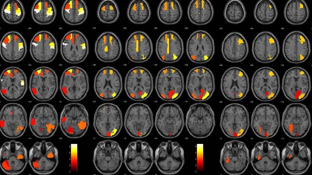 Ejemplo de imágenes de resonancia magnética funcional.