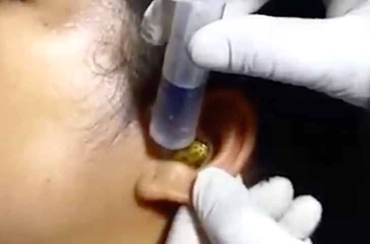 Serpiente viva en oreja de mujer