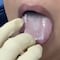 ¿Qué es la malla adelgazante lingual? El doloroso método en el que engrapan la lengua