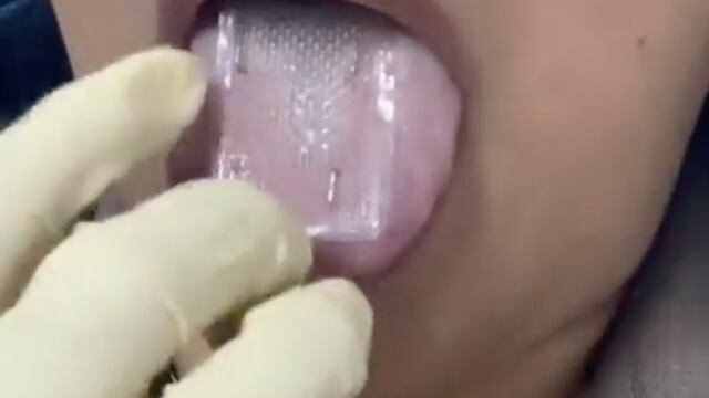 Malla adelgazante lingual