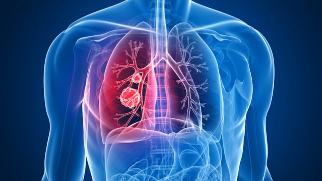 Cáncer Pulmón