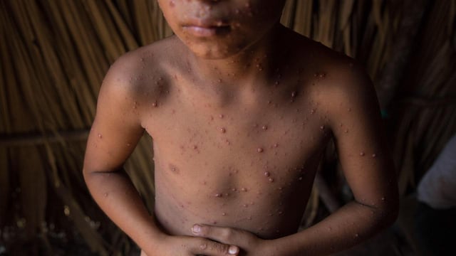 Culebrilla, enfermedad provocada por estrés