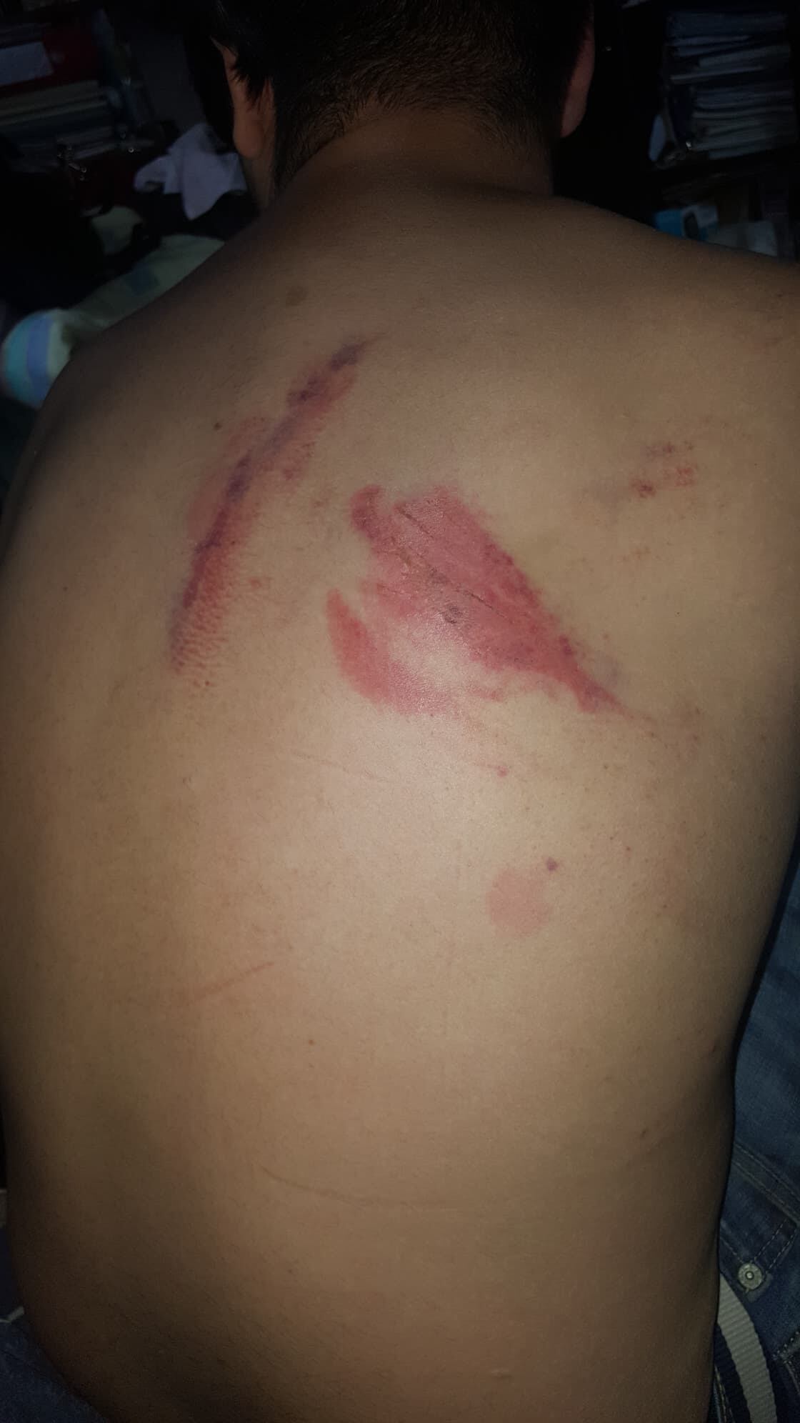 Golpes en cuerpo de las víctimas