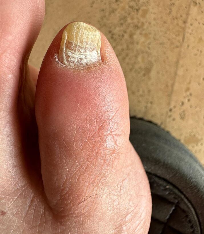 Chris Pratt comparte el hongo de su uña.