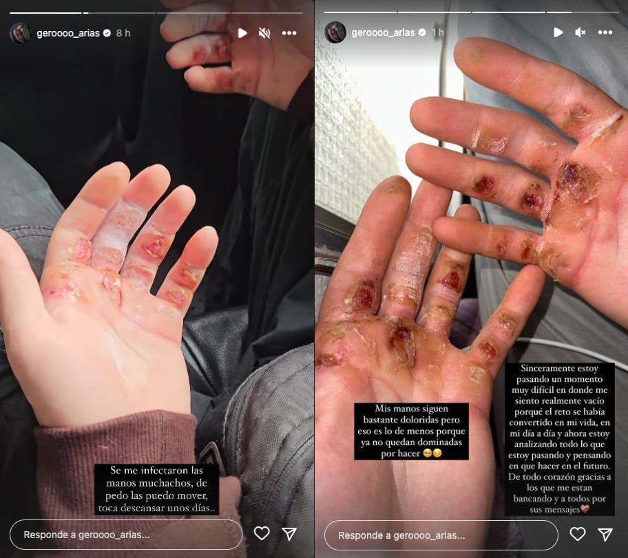 Gero Arias se toma un tiempo pensar en el futuro mientras se recupera de sus manos