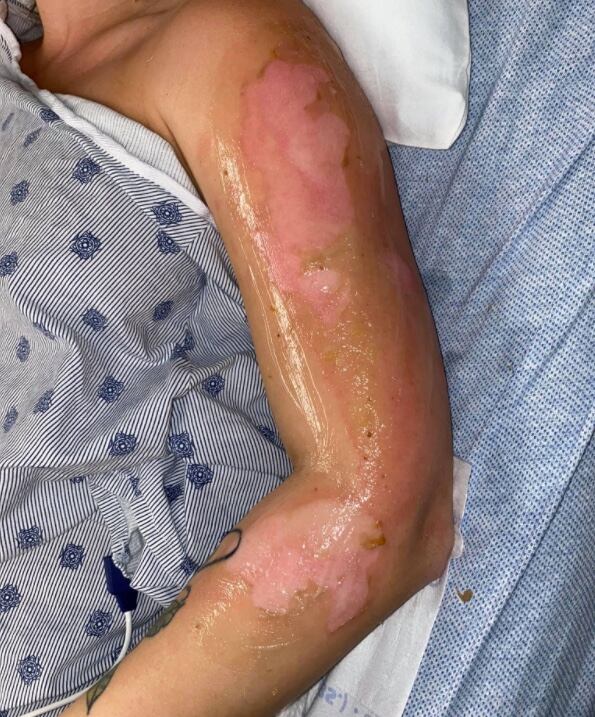 Quemaduras en turista