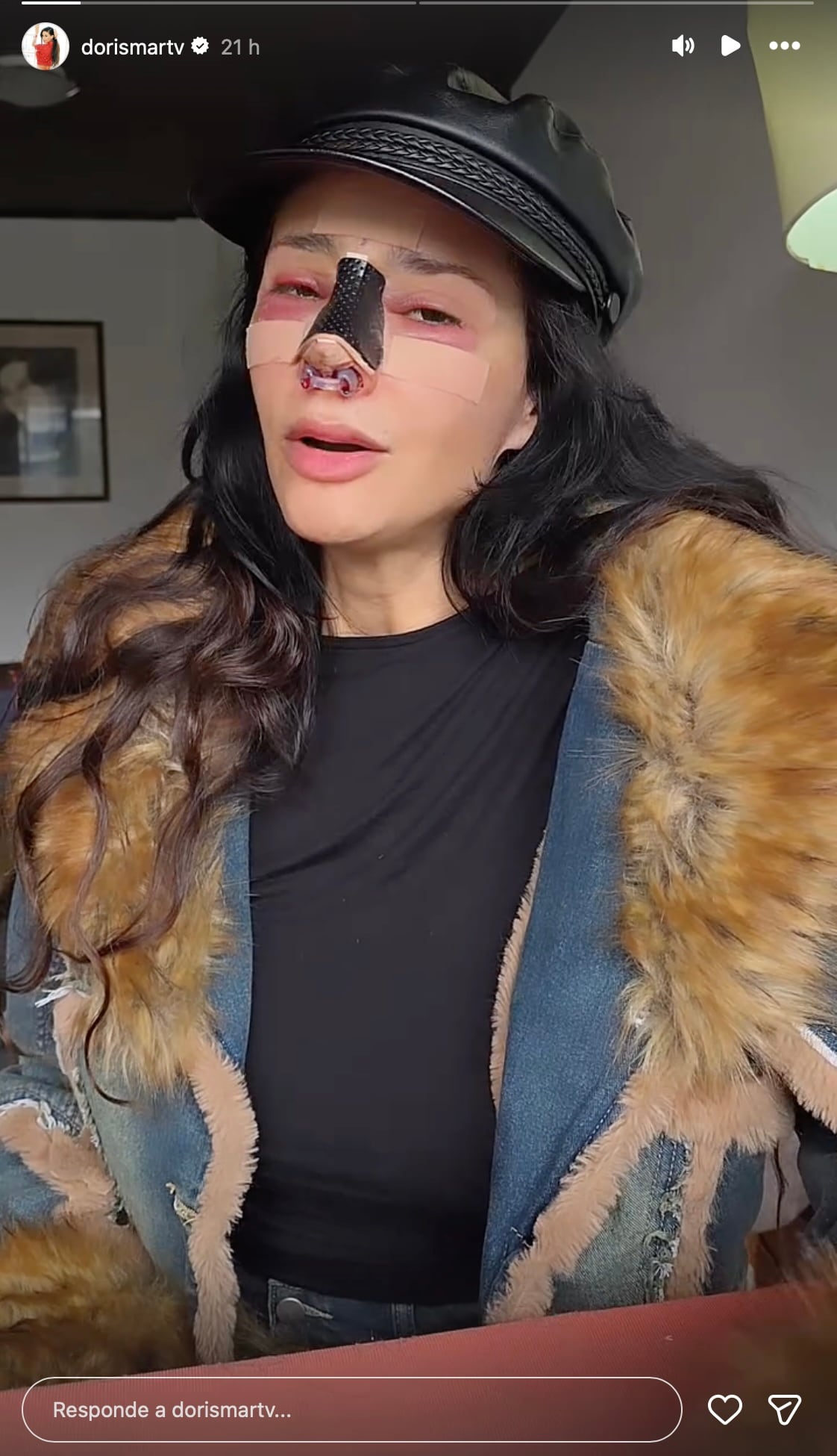 Así luce Dorismar tras una cirugía estética con complicaciones