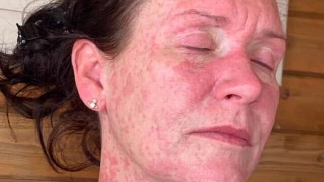 Reacción vacuna AstraZeneca