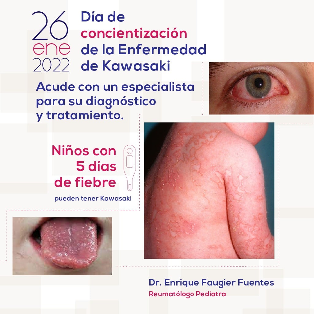 Enfermedad de Kawasaki