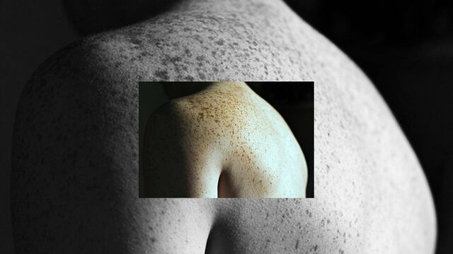 Además, tener más de cien lunares repartidos por todo el cuerpo representa un riesgo cinco veces mayor de sufrir melanoma.
