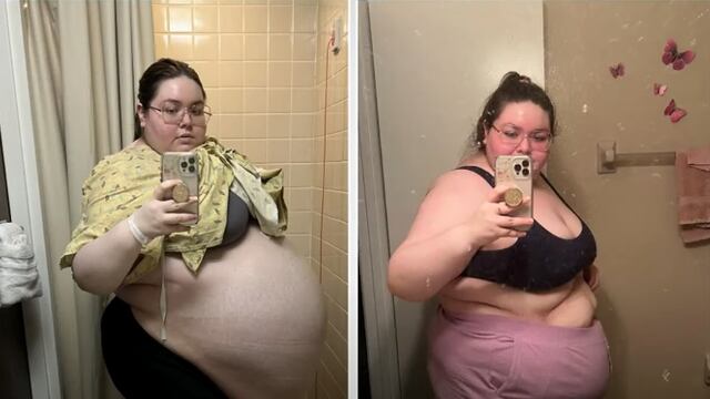 Allison Fisher, la mujer que pensó tenía obesidad pero estaba cargando un quiste