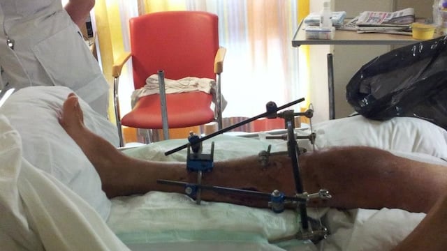 Hombre convierte su pierna amputada en lámpara. ¡La quería vender por eBay!