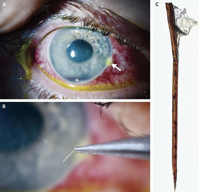 Hombre con aguijón en el ojo