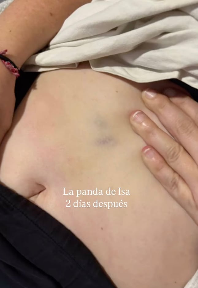 Así quedó el abdomen de Isabel Fernández tras el golpe de Bárbara de Regil