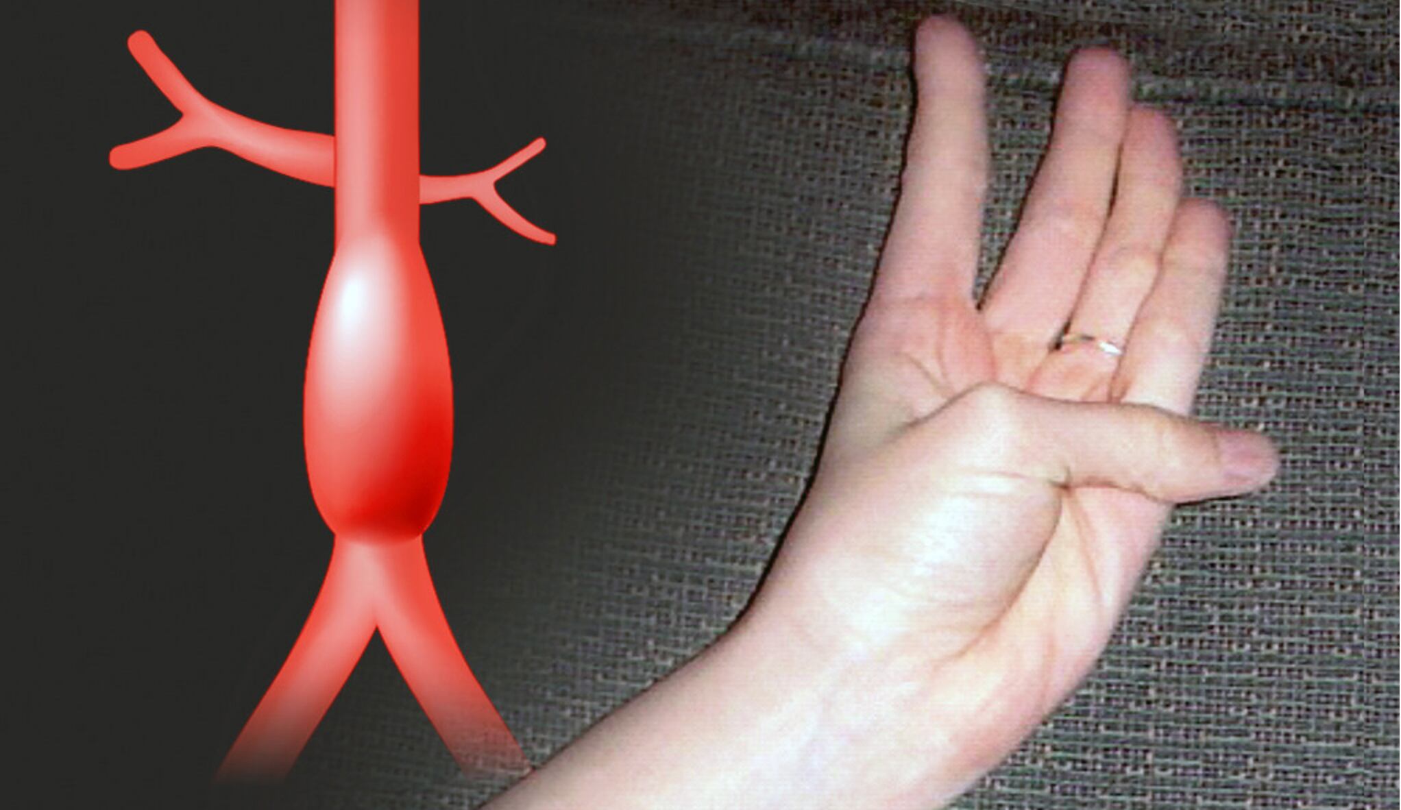 Ejercicio para detectar un aneurisma aórtico