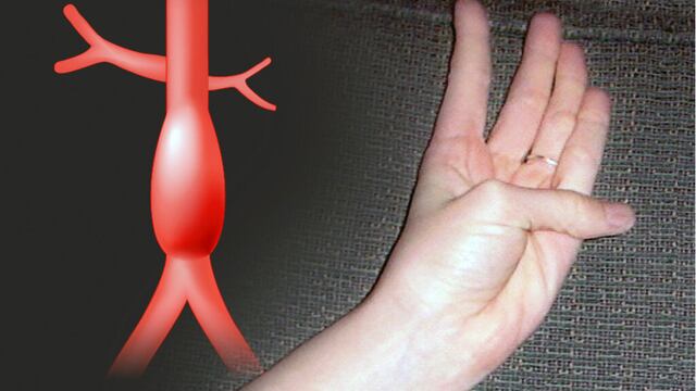 Ejercicio para detectar un aneurisma aórtico
