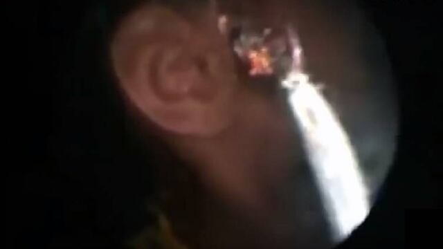 Hormigas en el oído de una niña en la India.