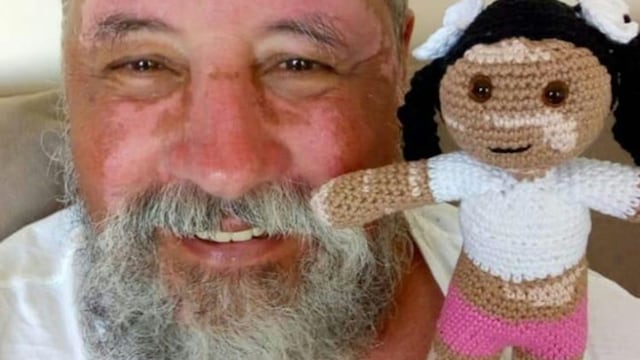 Muñeca Vitiligo