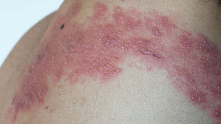 Covid-19: Relacionan vacuna de Pfizer con herpes zóster