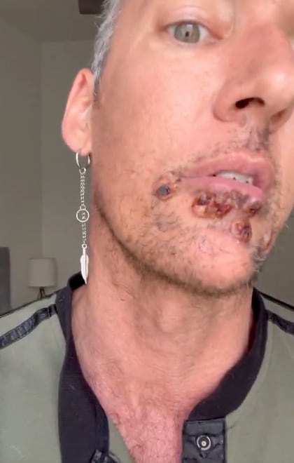 Actor porno con Viruela del Mono