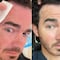 Kevin de los Jonas Brothers detectó un lunar extraño en su cara y resultó ser cáncer