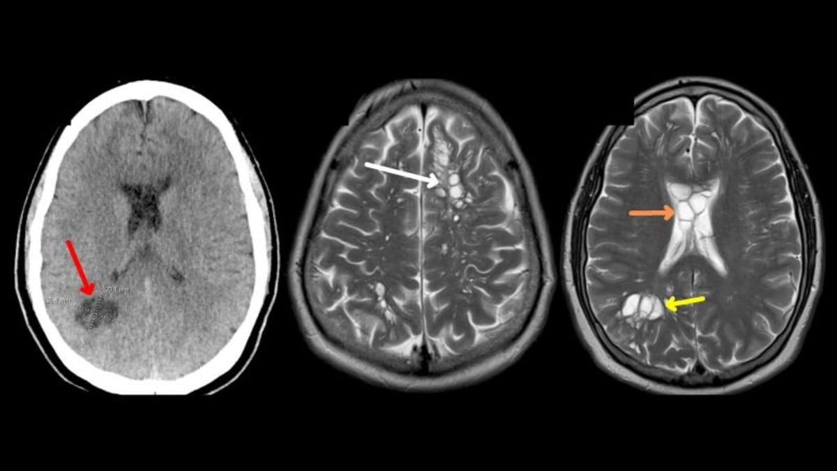 Consumo de tocino habría desatado que hombre tuviera larvas en el cerebro