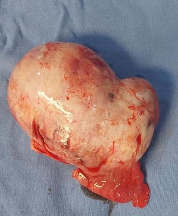 Verónica del Castillo muestra su tumor