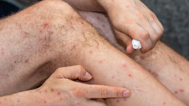 Gripe del tomate: qué es, síntomas y cómo se contagia