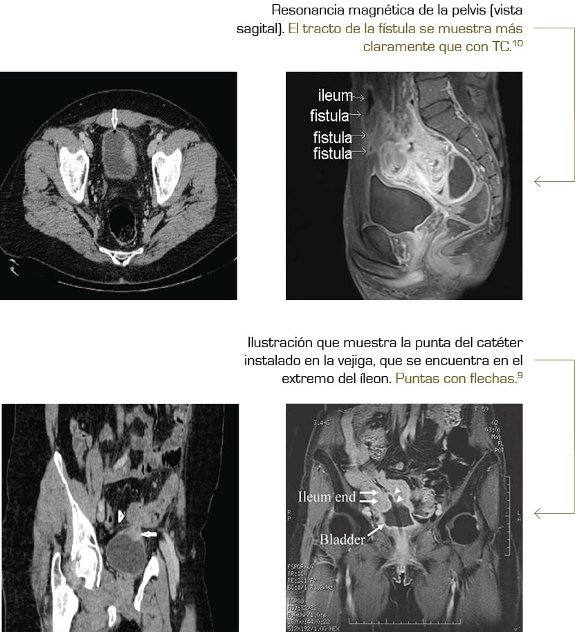 Identificación de una fístula