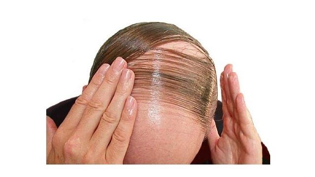5 consejos para evitar la calvicie.
